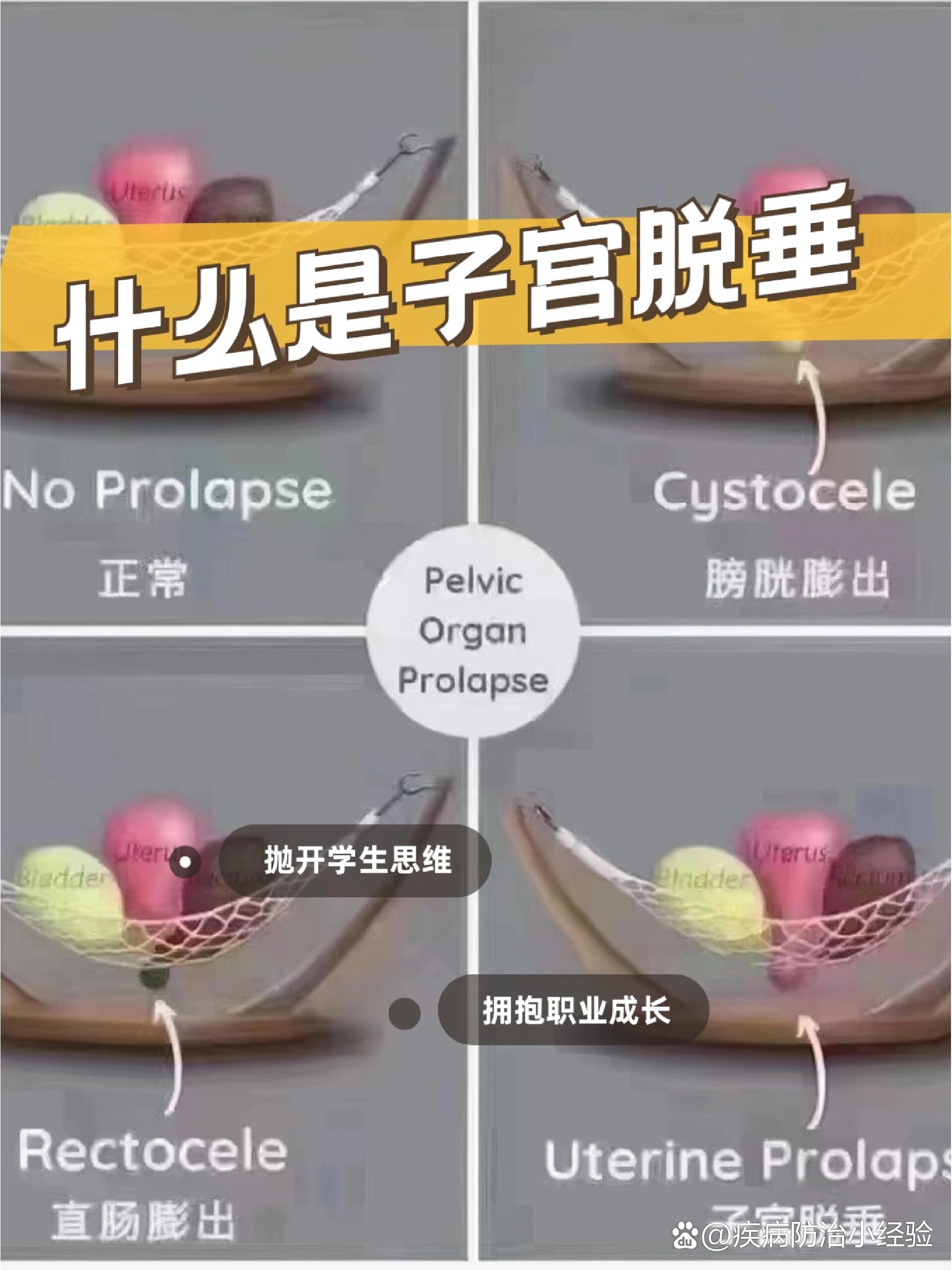 什么是子宫脱垂