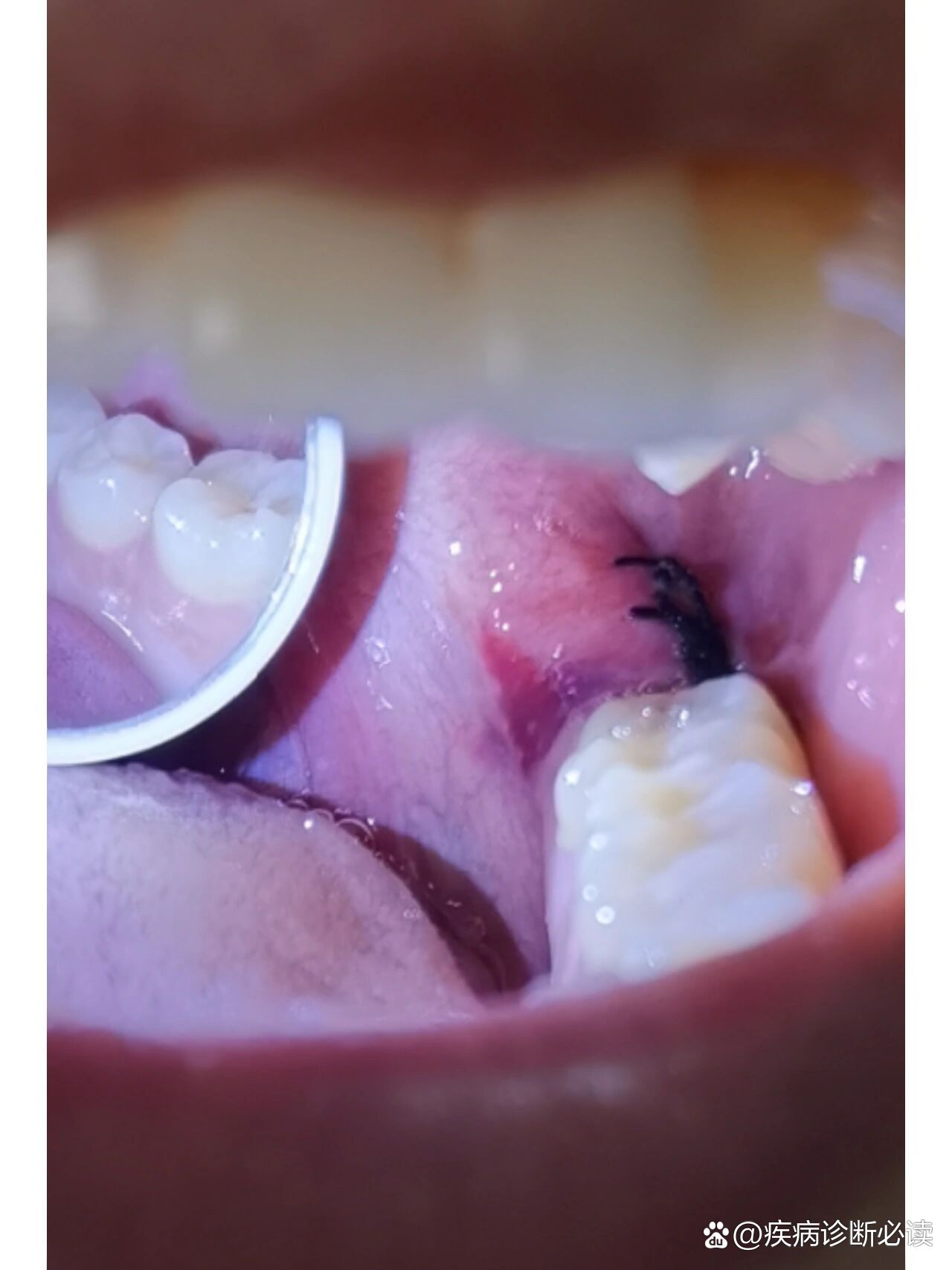 拔完智齿啦(图2慎点哦dbq是我缝线的牙洞)