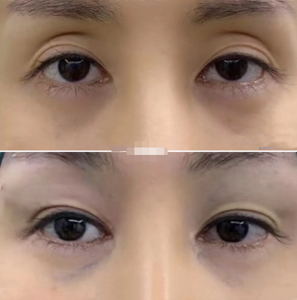 什么原因会出现眼窝凹陷呢,该如何改善眼窝凹陷?