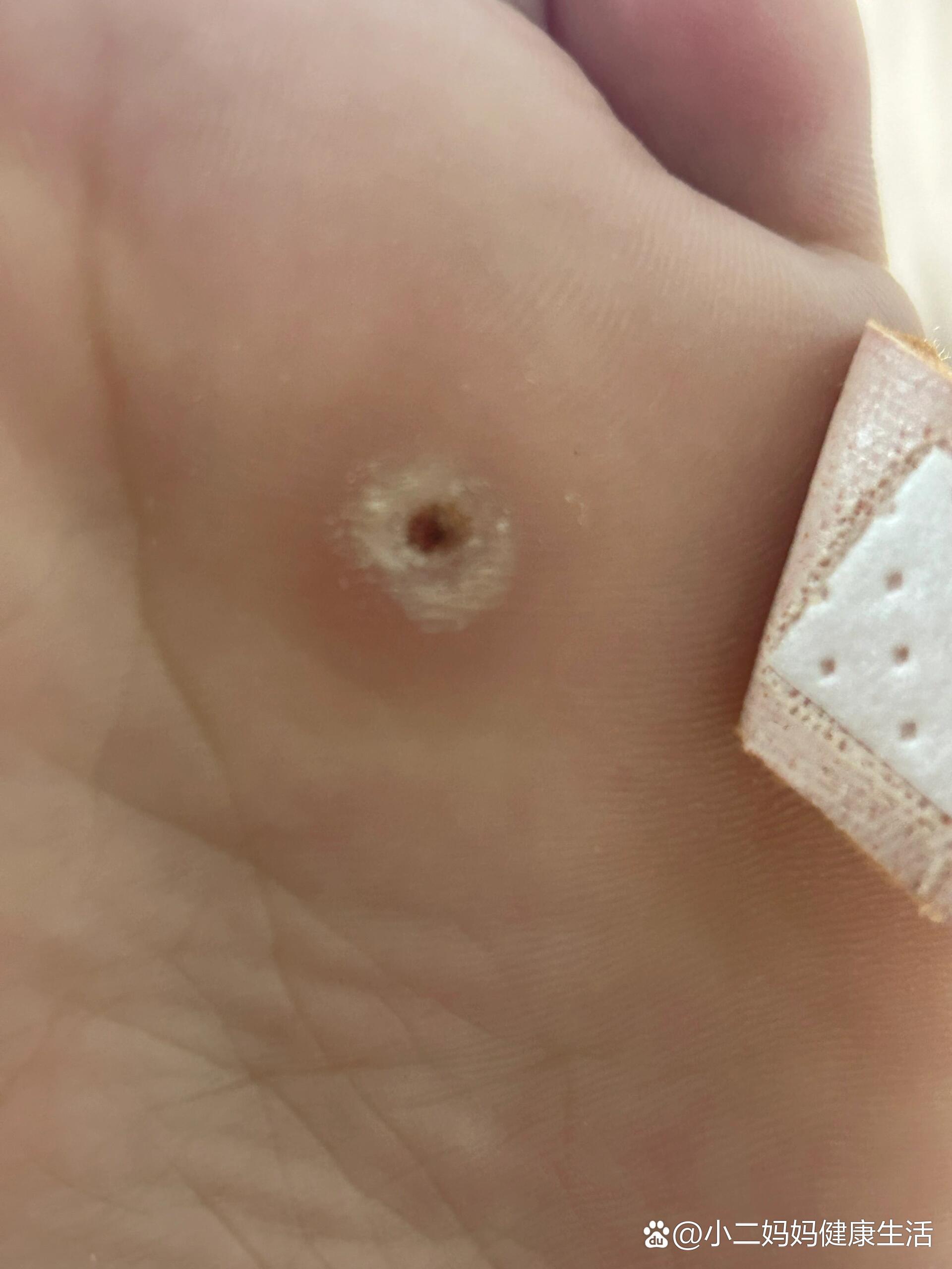 鸡眼