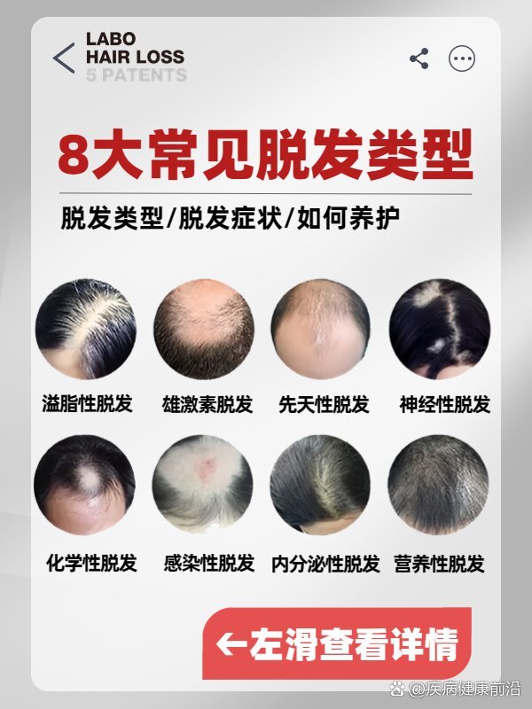 81566大常见脱发类型及养护干货75快来自测