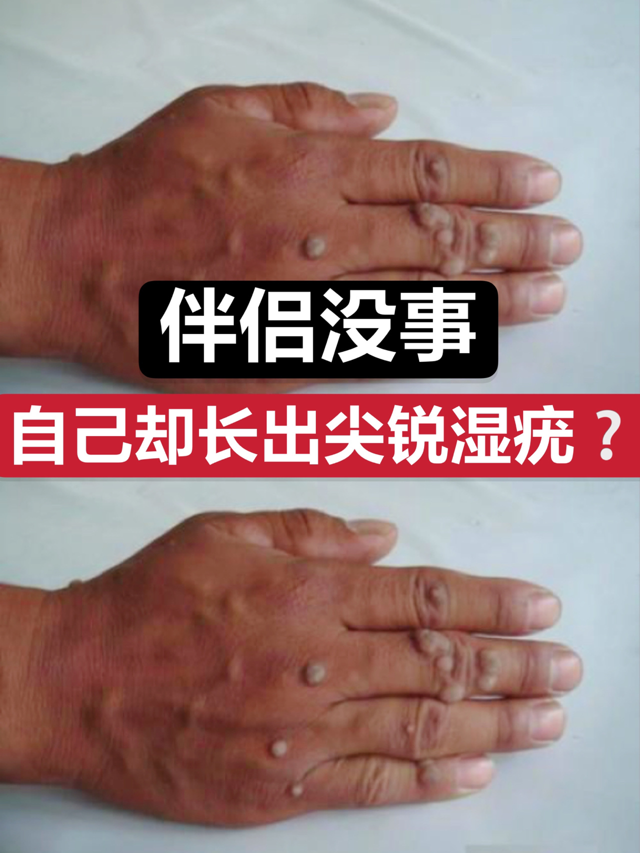 伴侣没事自己却得了尖锐湿疣是怎么回事?