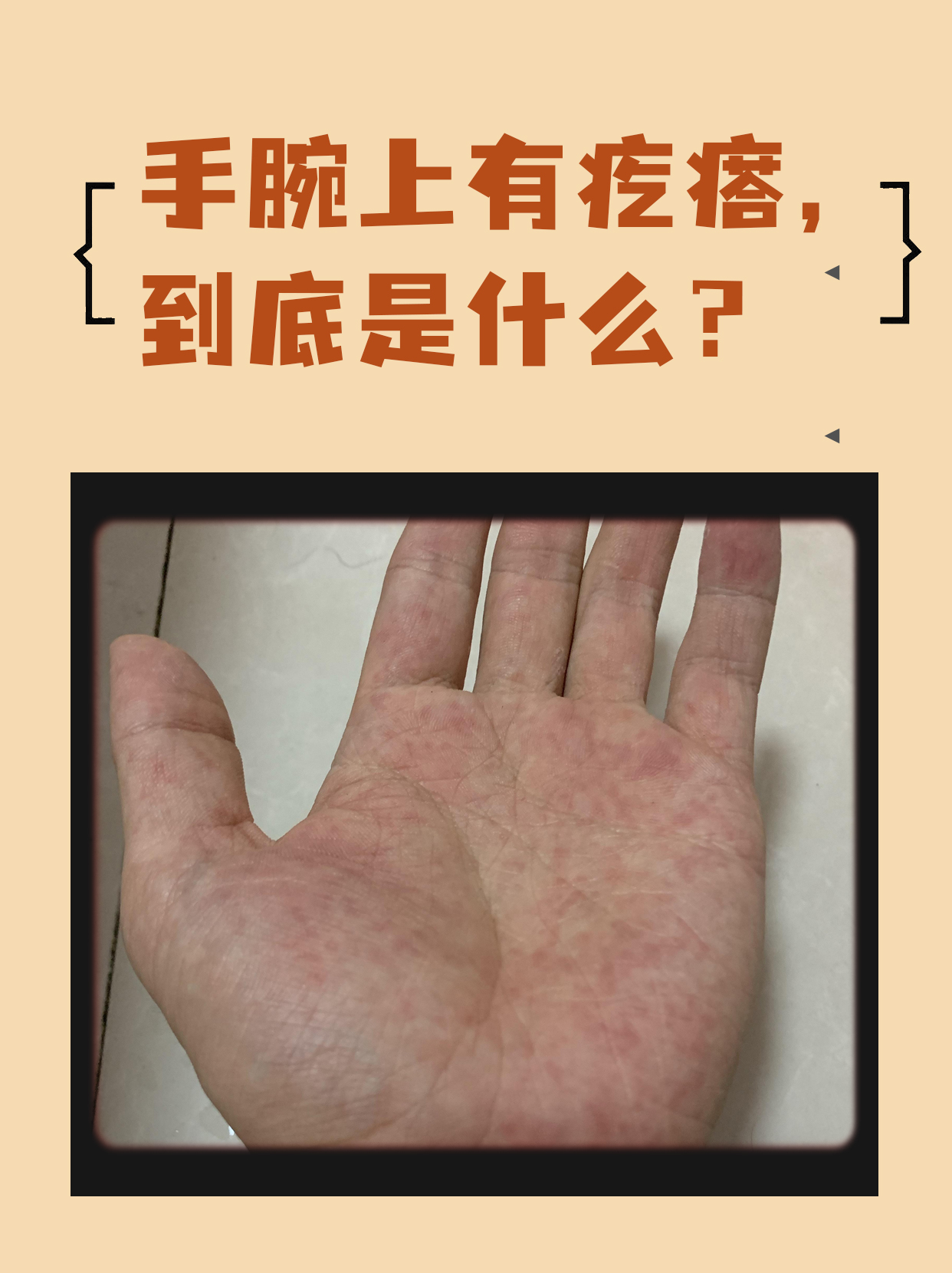 手心越抓越痒?原因和应对方法在这里!