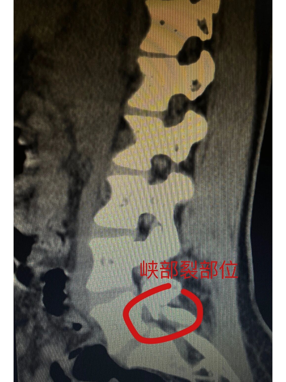 年轻患者腰椎峡部裂该如何治疗?