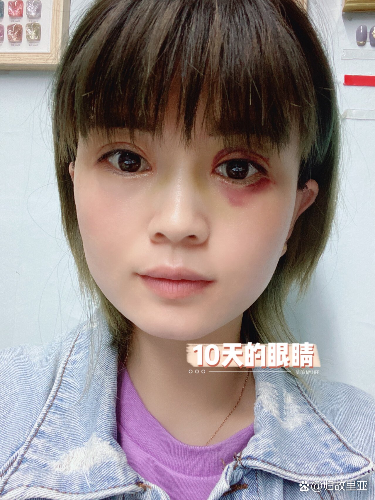 紫色淤青慢慢消退吧