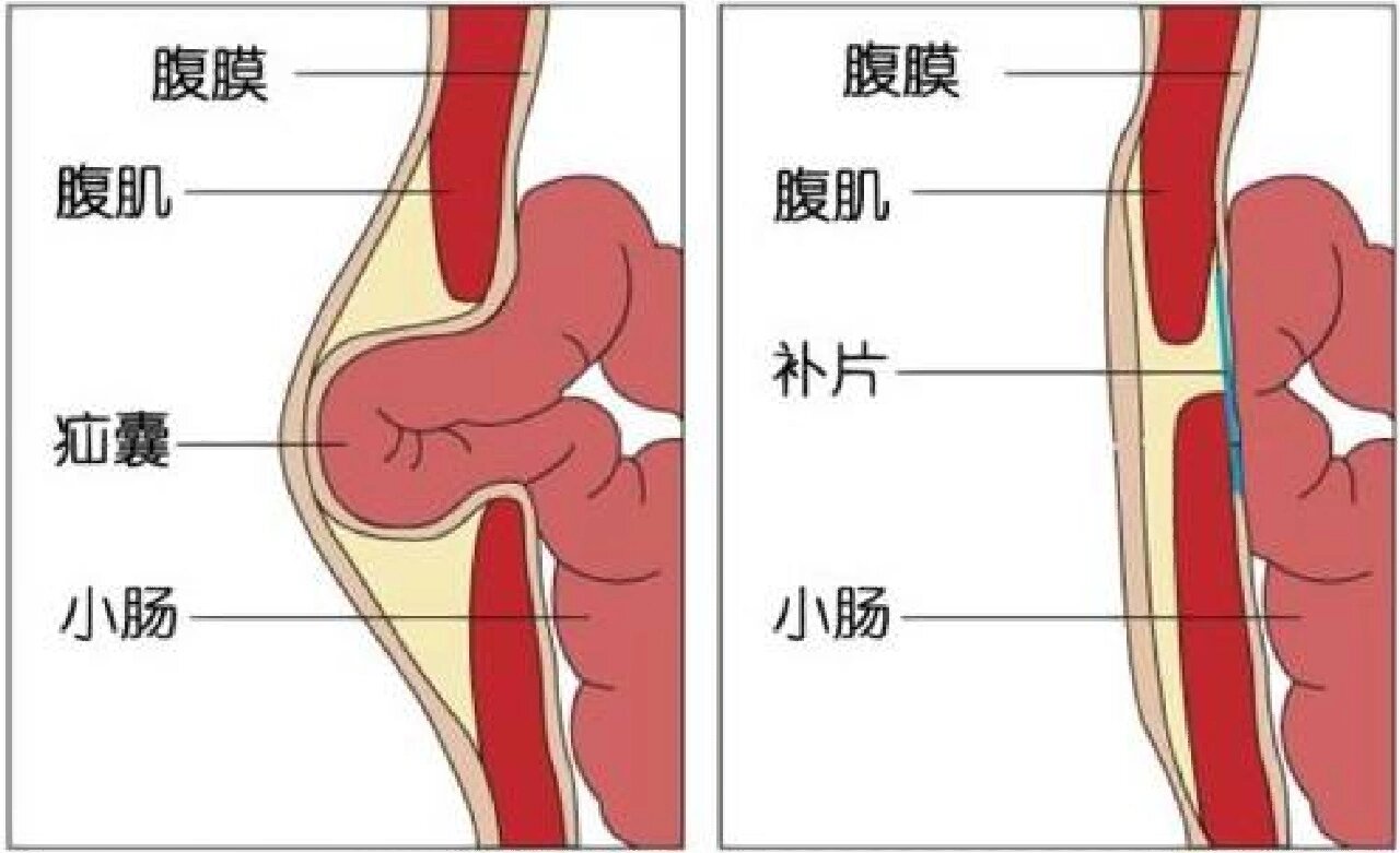 成人脐疝的图片初期图片