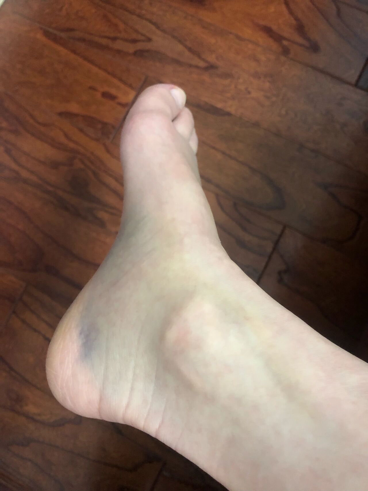 崴脚了以后恢复可慢呀