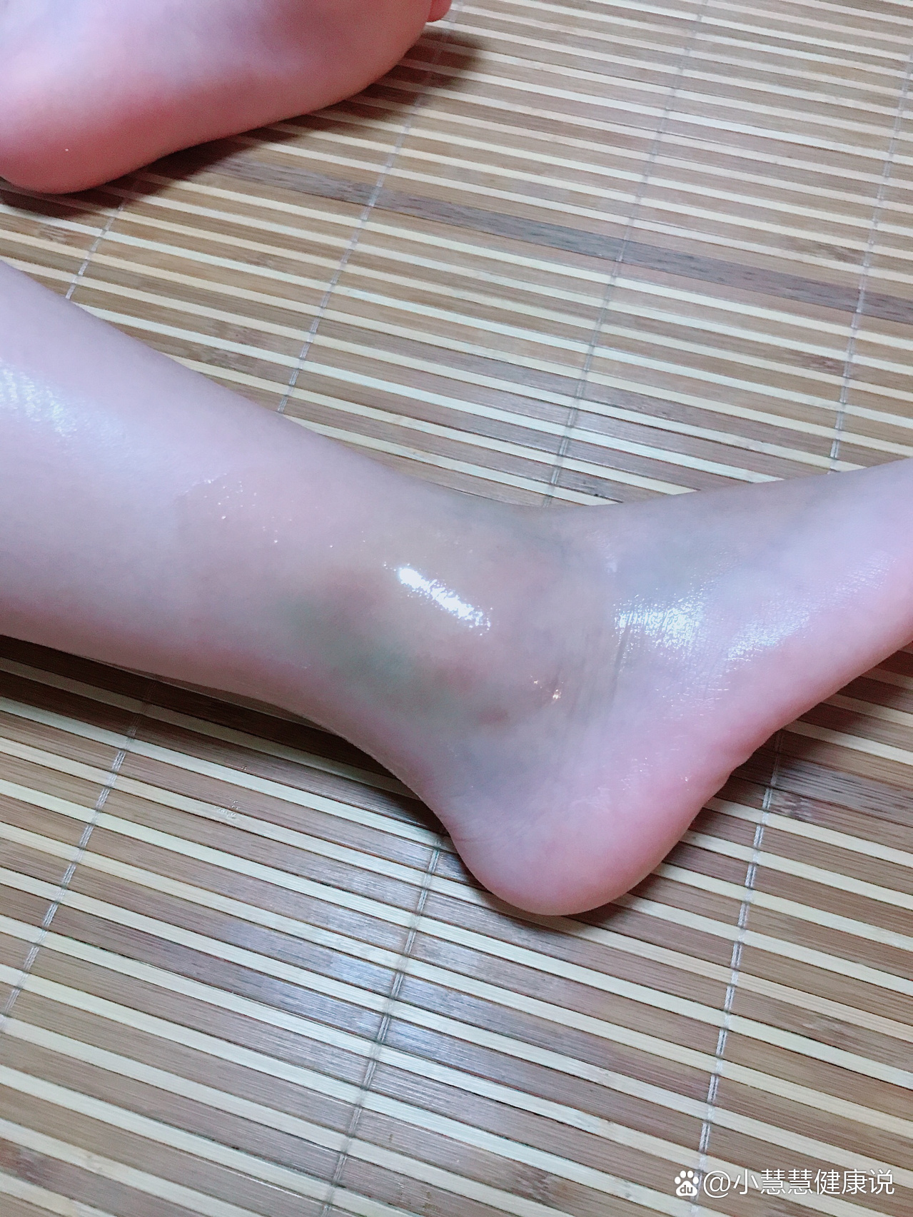 针对无骨折性扭伤,如剧烈疼痛还是要及时就医)  br>16615崴脚第一