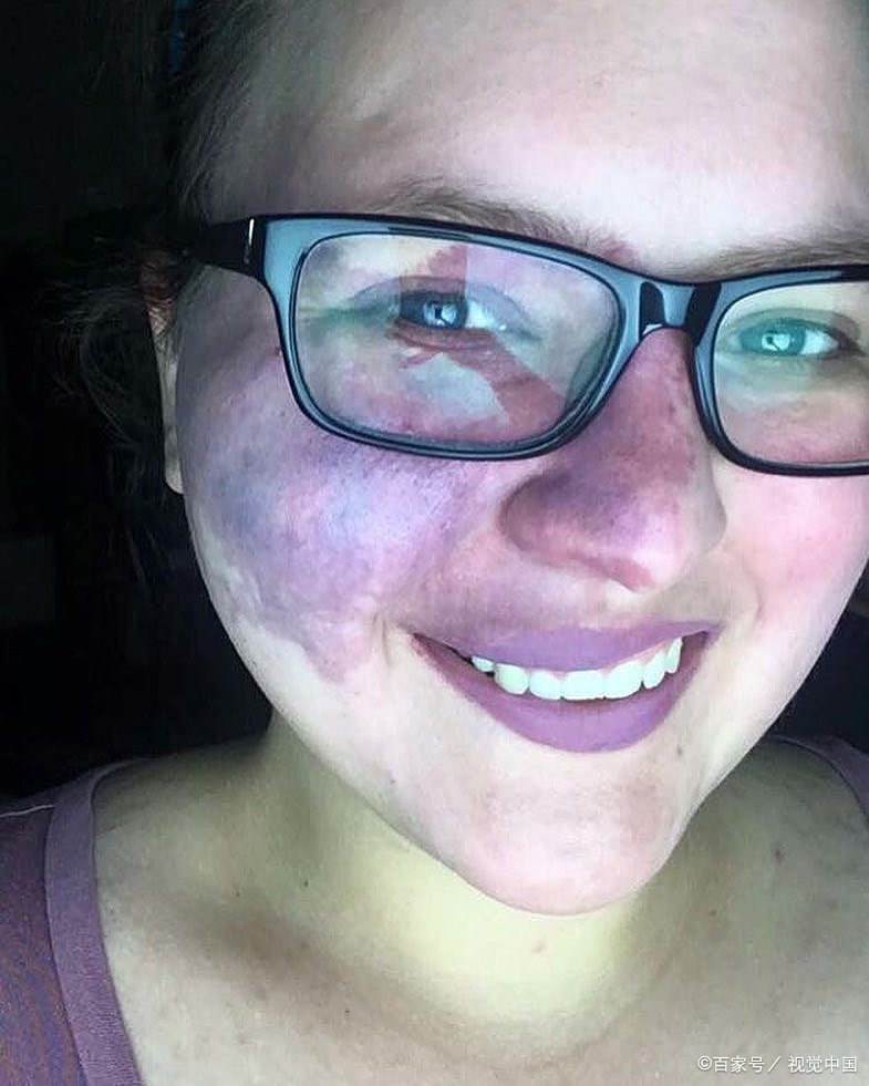 去胎记大约需要多少钱