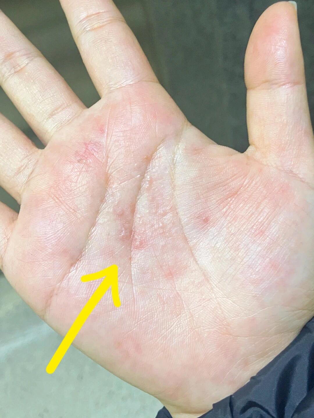 手心长这个痒到不行