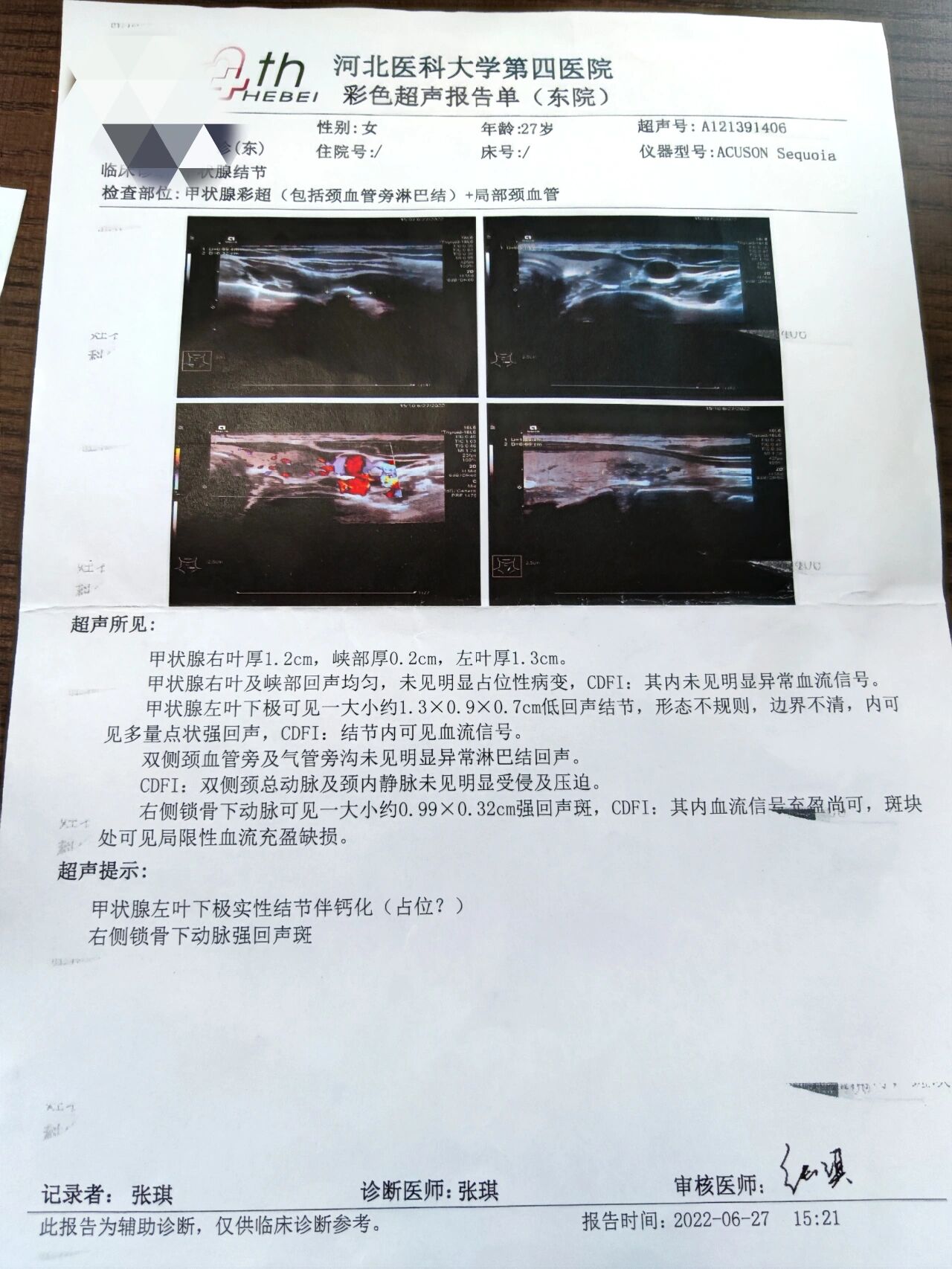 甲状腺乳头状癌