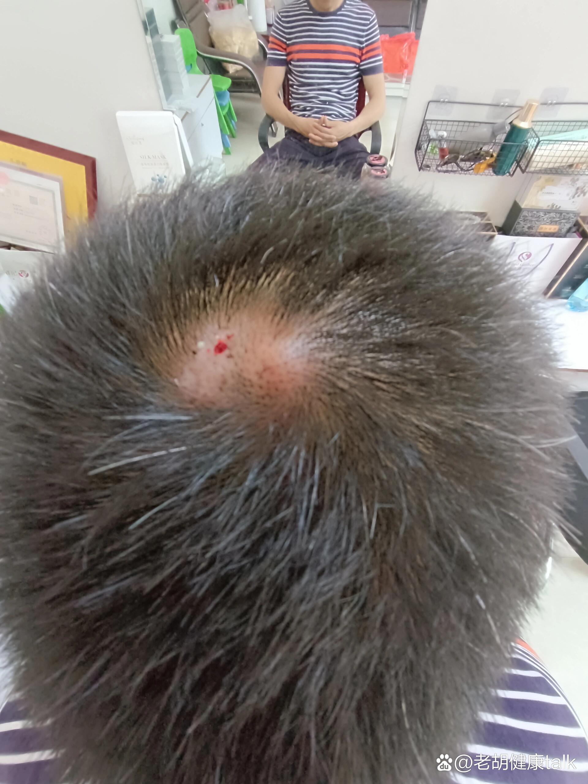 客户几年的毛囊炎导致不长头发,人参精油疏通两次,头发就生长出来了