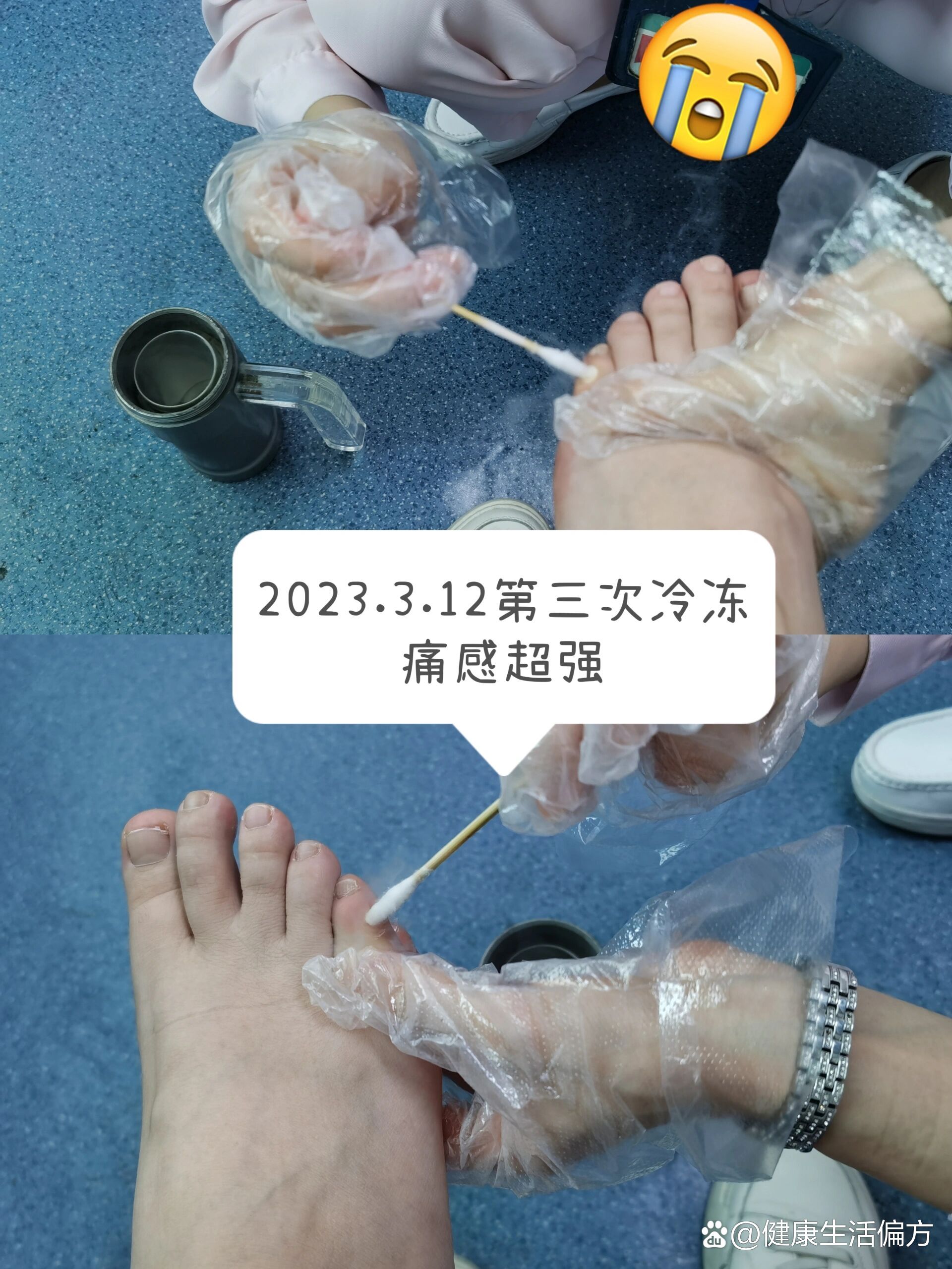 液氮冷冻鸡眼第三次