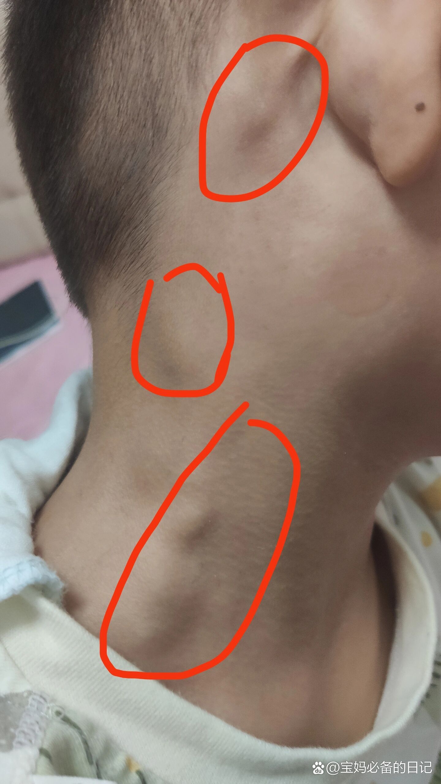 淋巴结肿大,可能是白血病