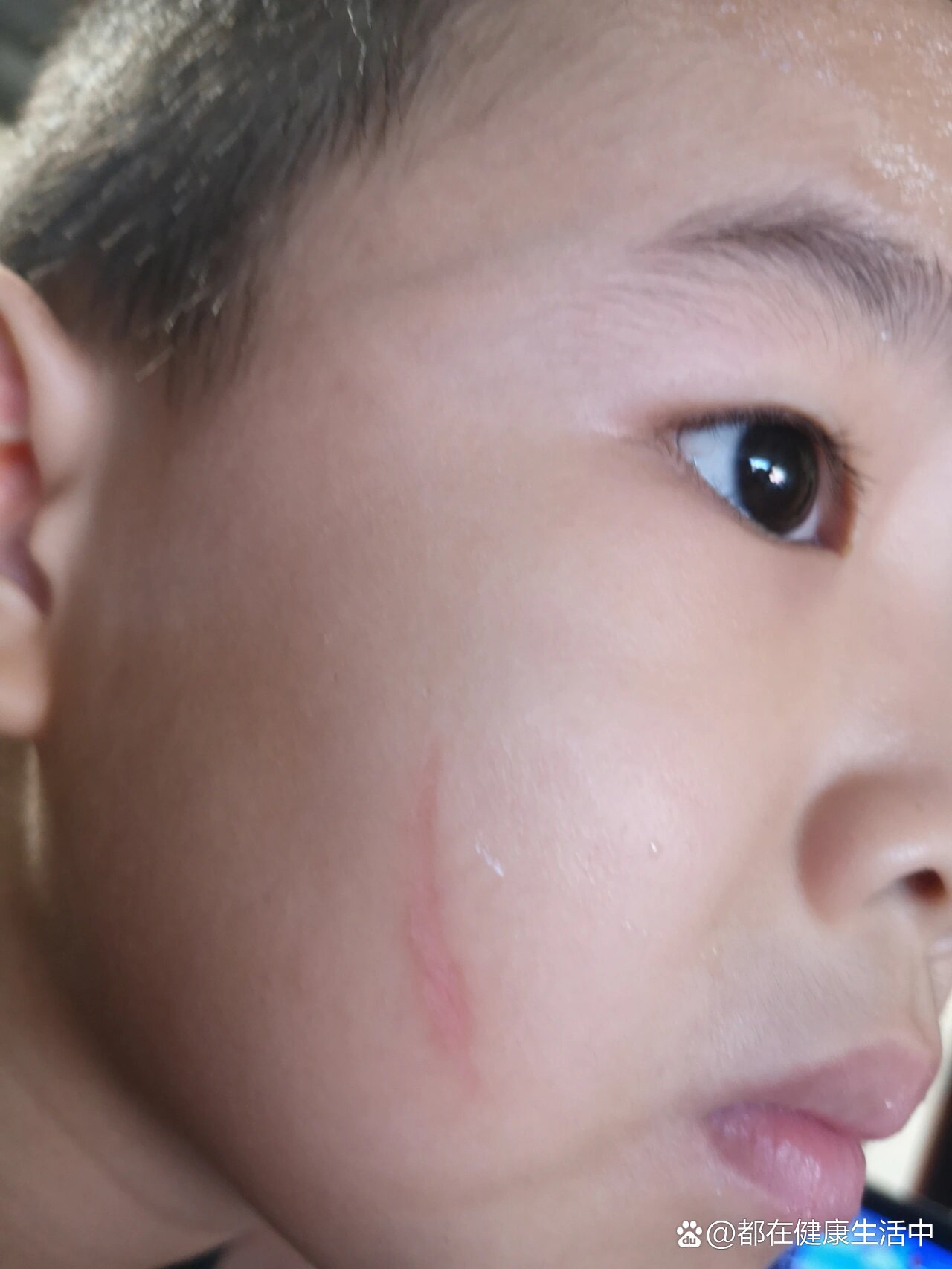 被抓伤,掉了一层皮的凹陷疤痕.