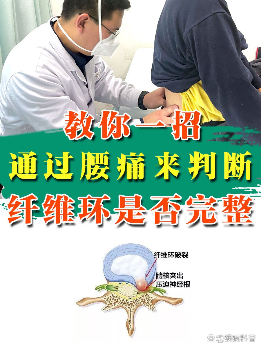 腰椎间盘突出症,纤维环破裂,能修复吗?