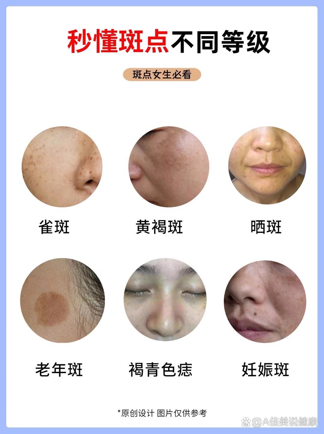 🔥1⃣「雀斑」面部较小的黄褐色或褐色的色素沉着,一般5~7岁