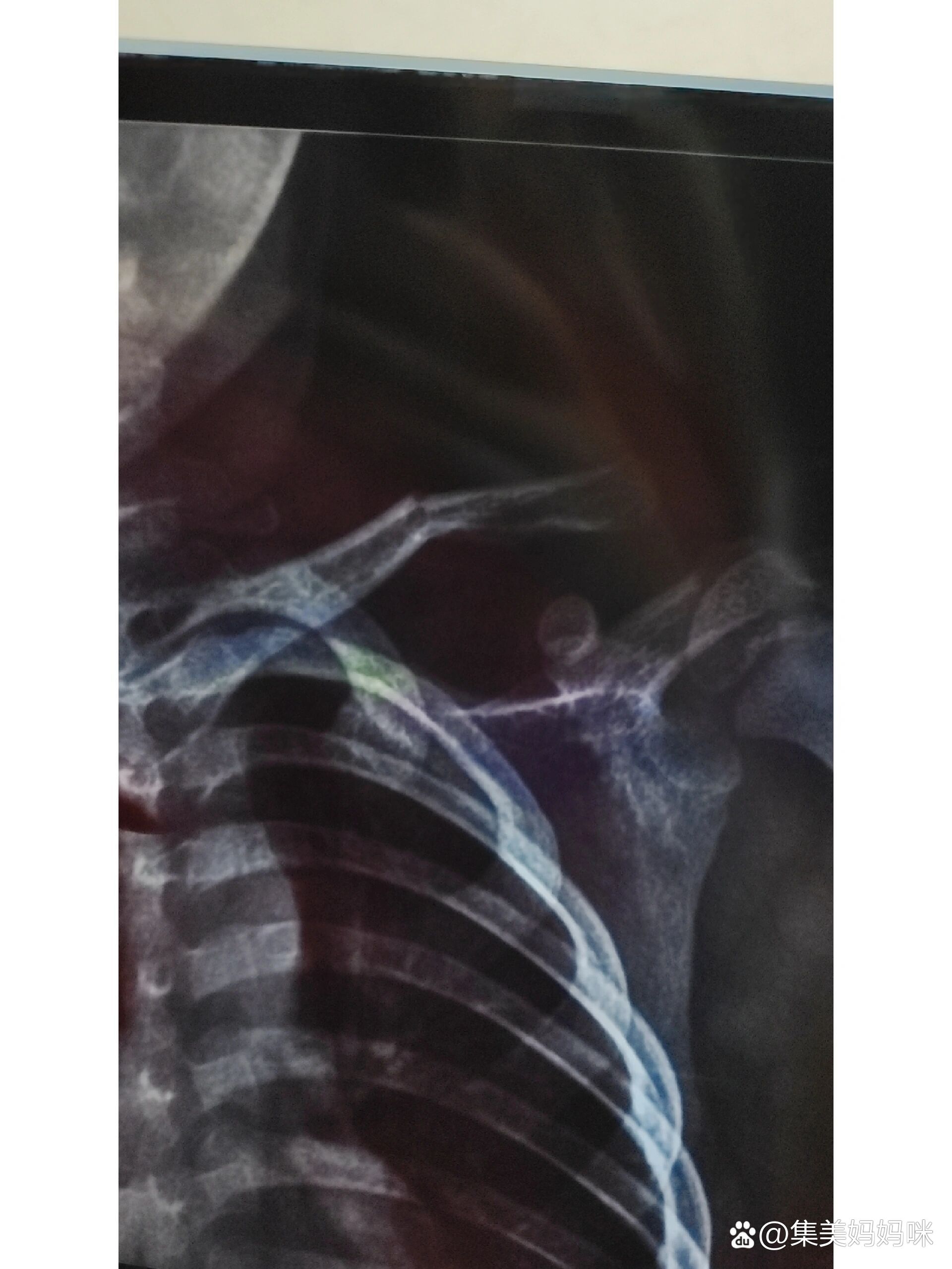 2岁小朋友锁骨骨折了