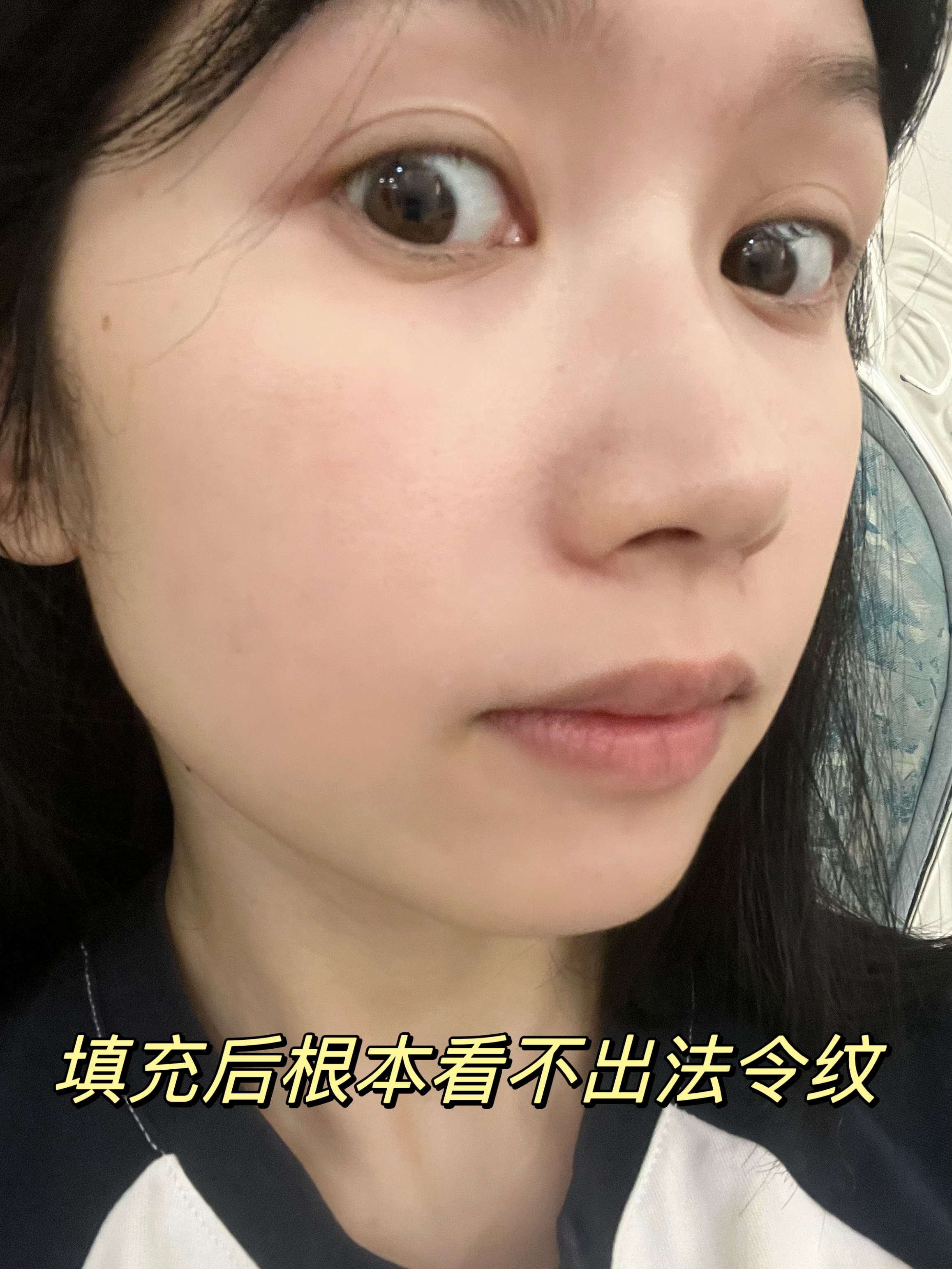 玻尿酸填充法令纹真是立竿见影