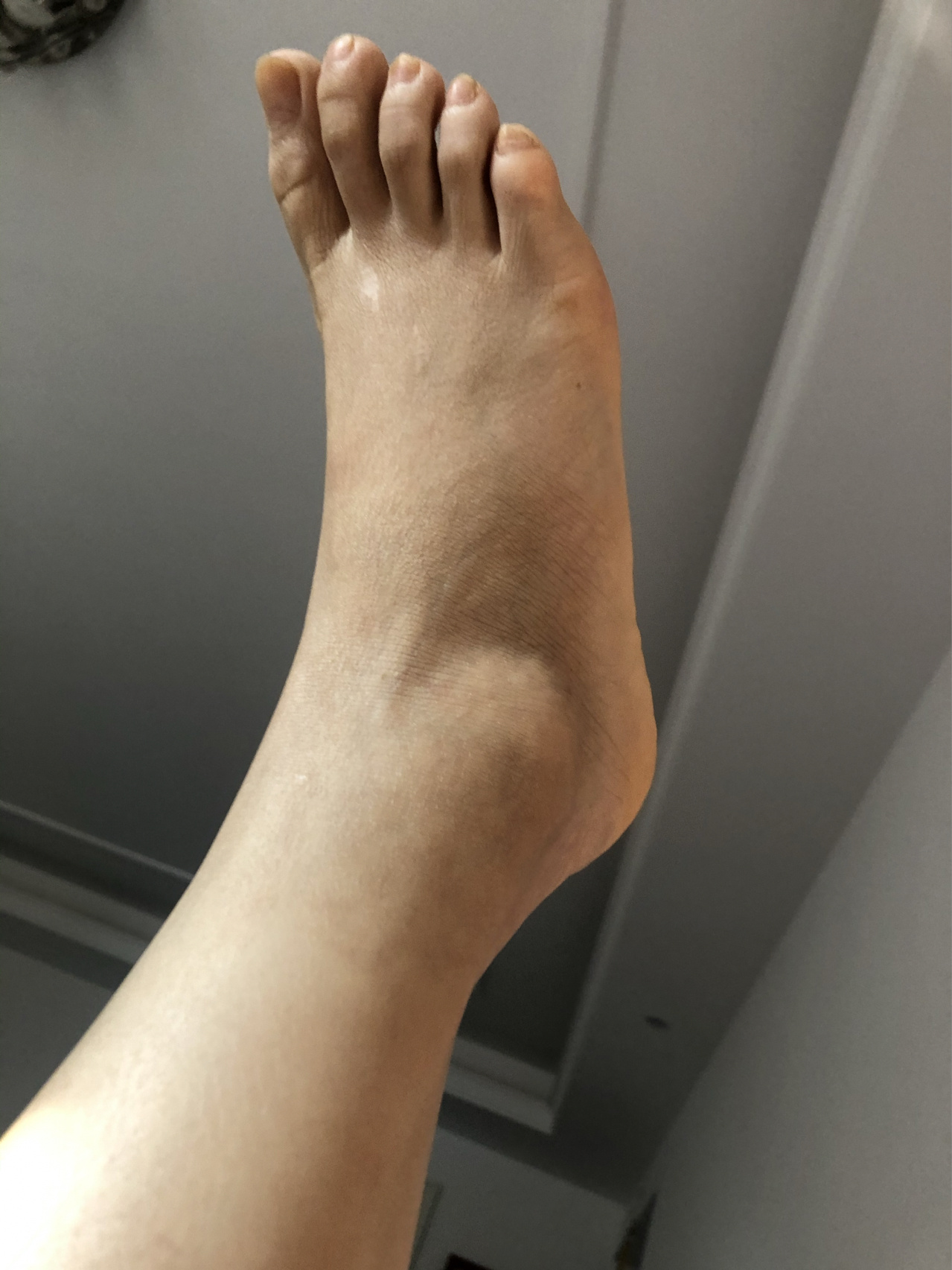 脚踝扭伤三个月