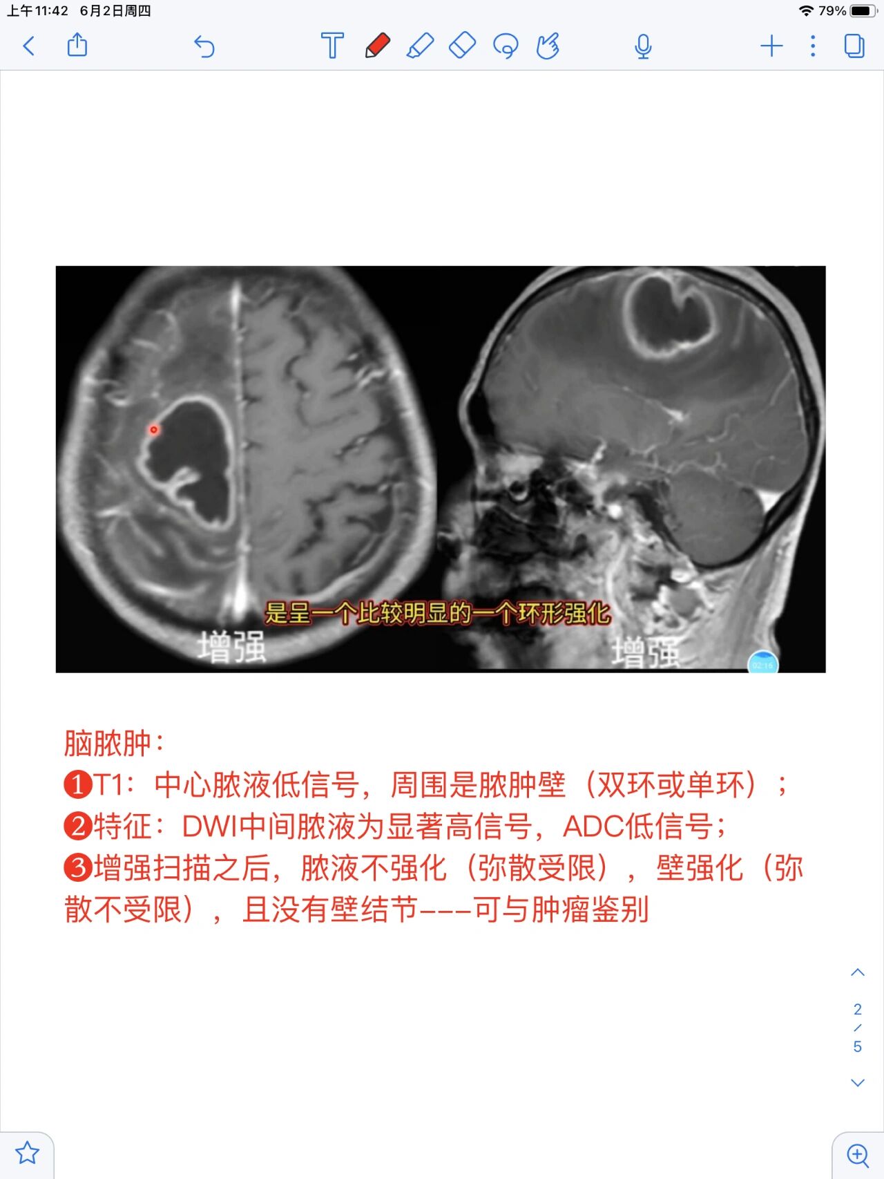 脑脓肿磁共振表现图像图片