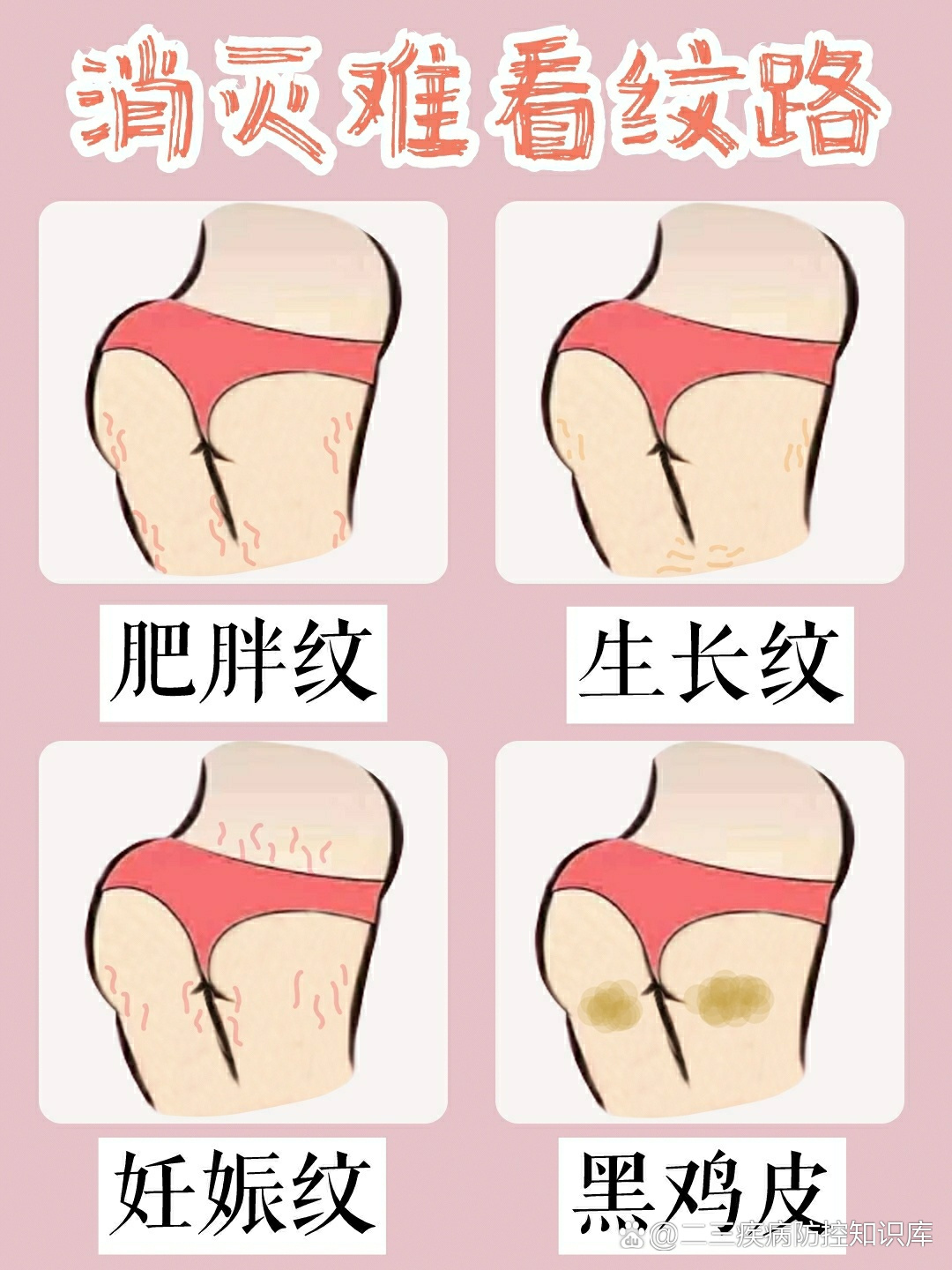 乳房肥胖纹图片