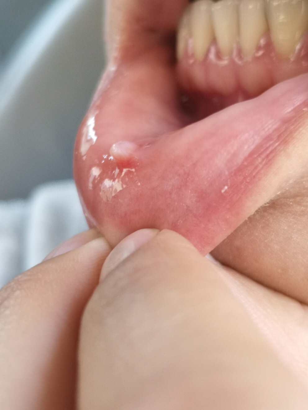 粘液腺囊肿