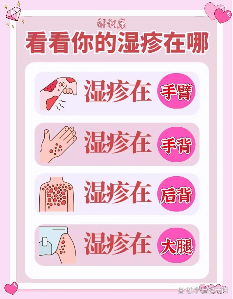 看看你的湿疹在哪里,引起湿疹的四大原因