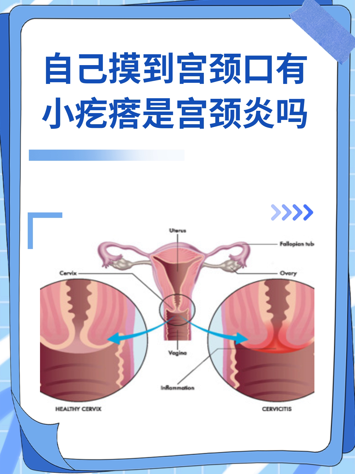 自己摸到宫颈口有小疙瘩是宫颈炎吗