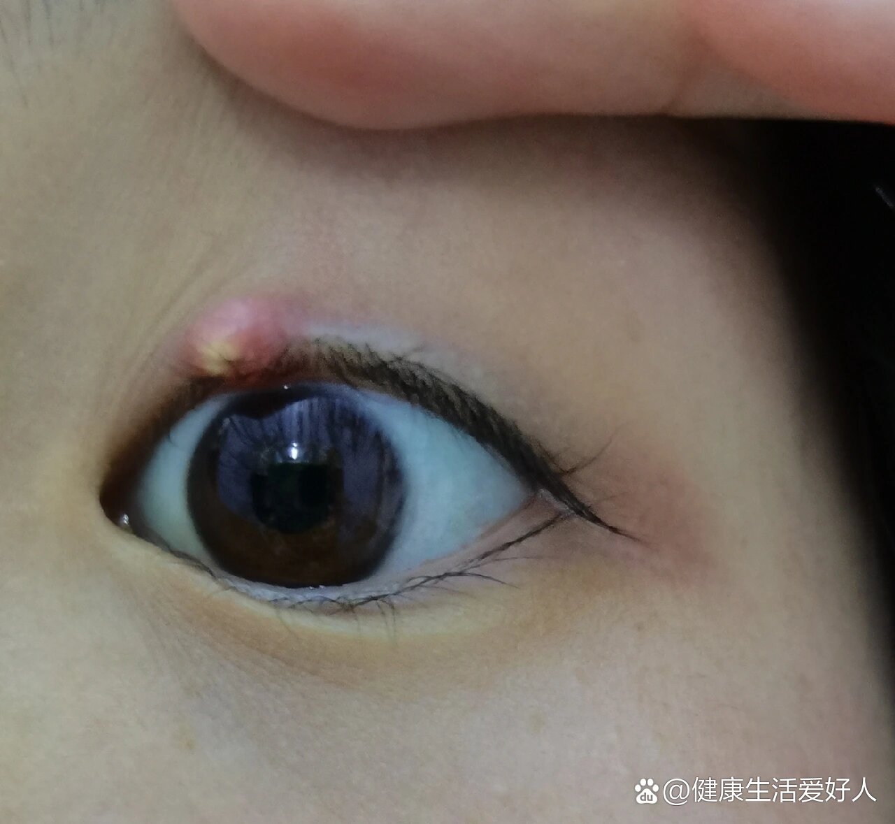 麦粒肿出现白色是快好了还是越来越严重啦