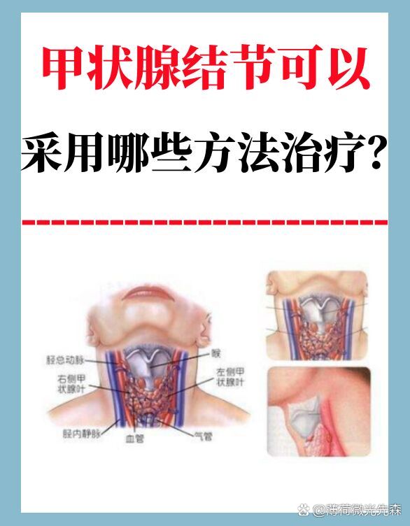 甲状腺结节可以采用哪些方法治疗?