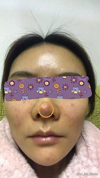 1️⃣ 感染:线雕隆鼻过程中,如果手术操作不够无菌化