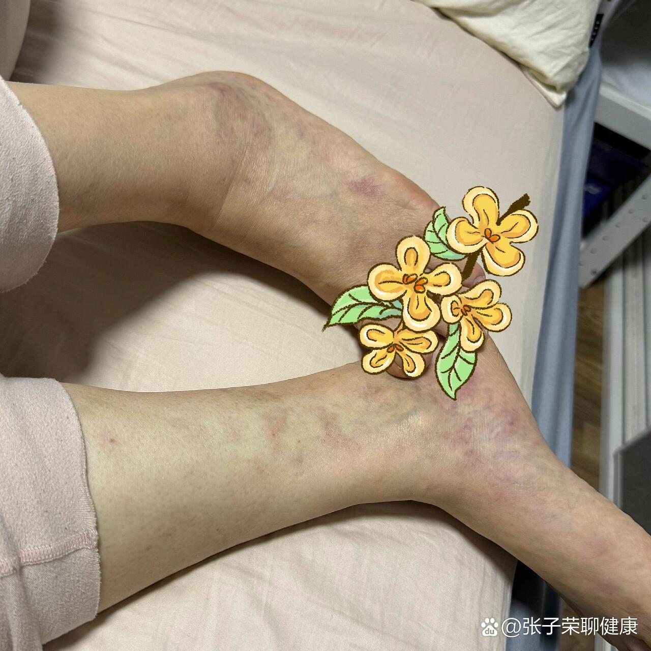  br>妈妈一侧腿有静脉曲张  br>与这个有关系吗?