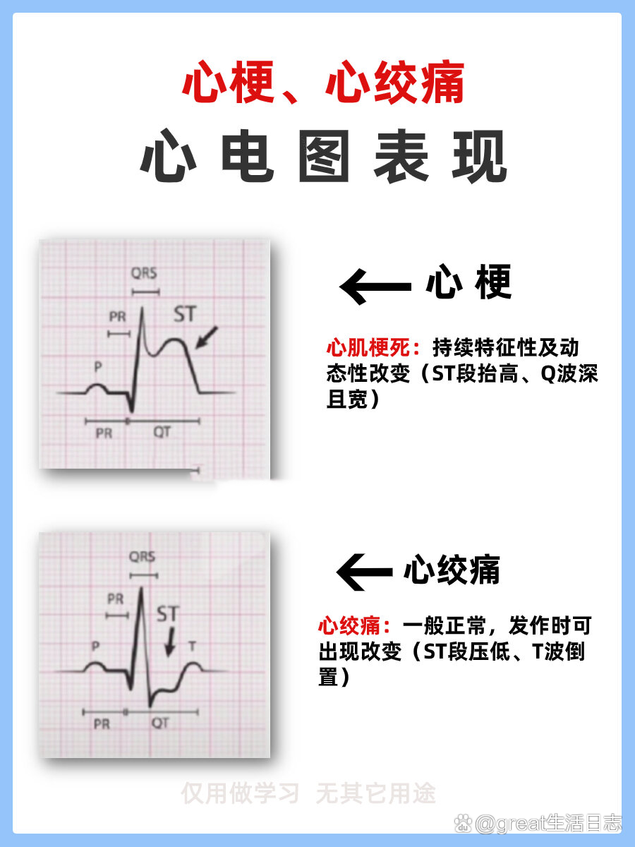 心绞痛心电图变化图片