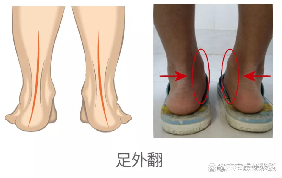 儿童足外翻图片症状图片