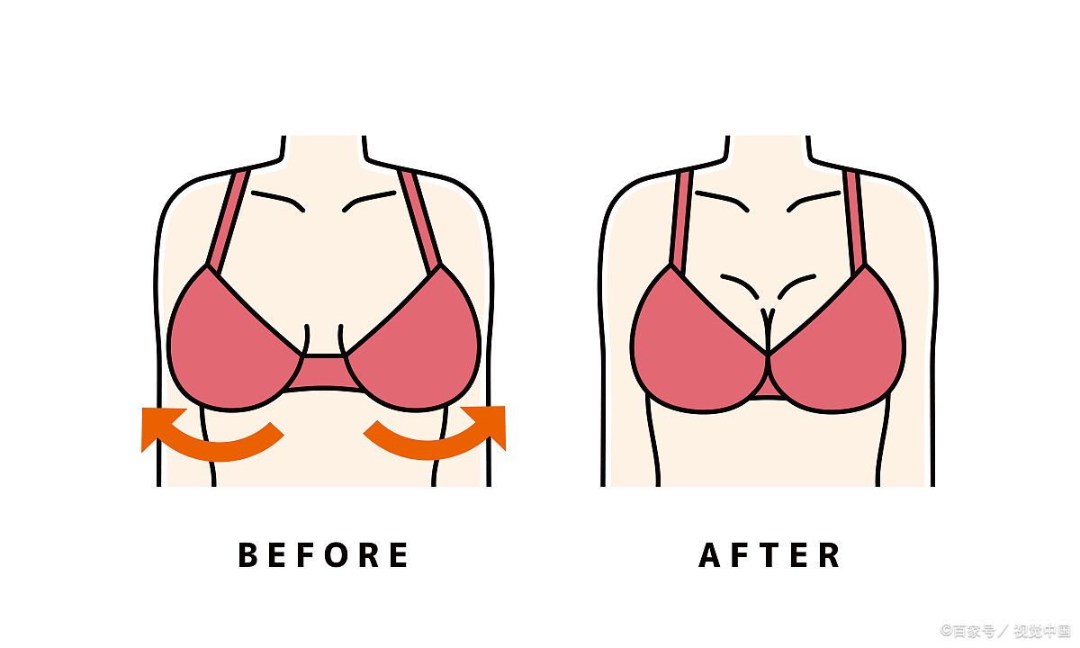 关于缩胸手术科普片