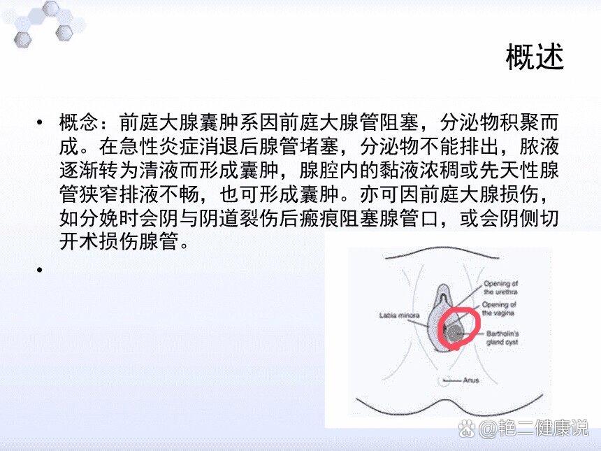 前庭大腺囊肿(巴氏囊肿)