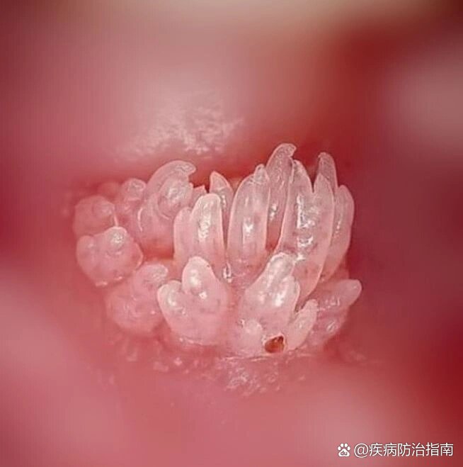 系带旁腺增生特征图片图片