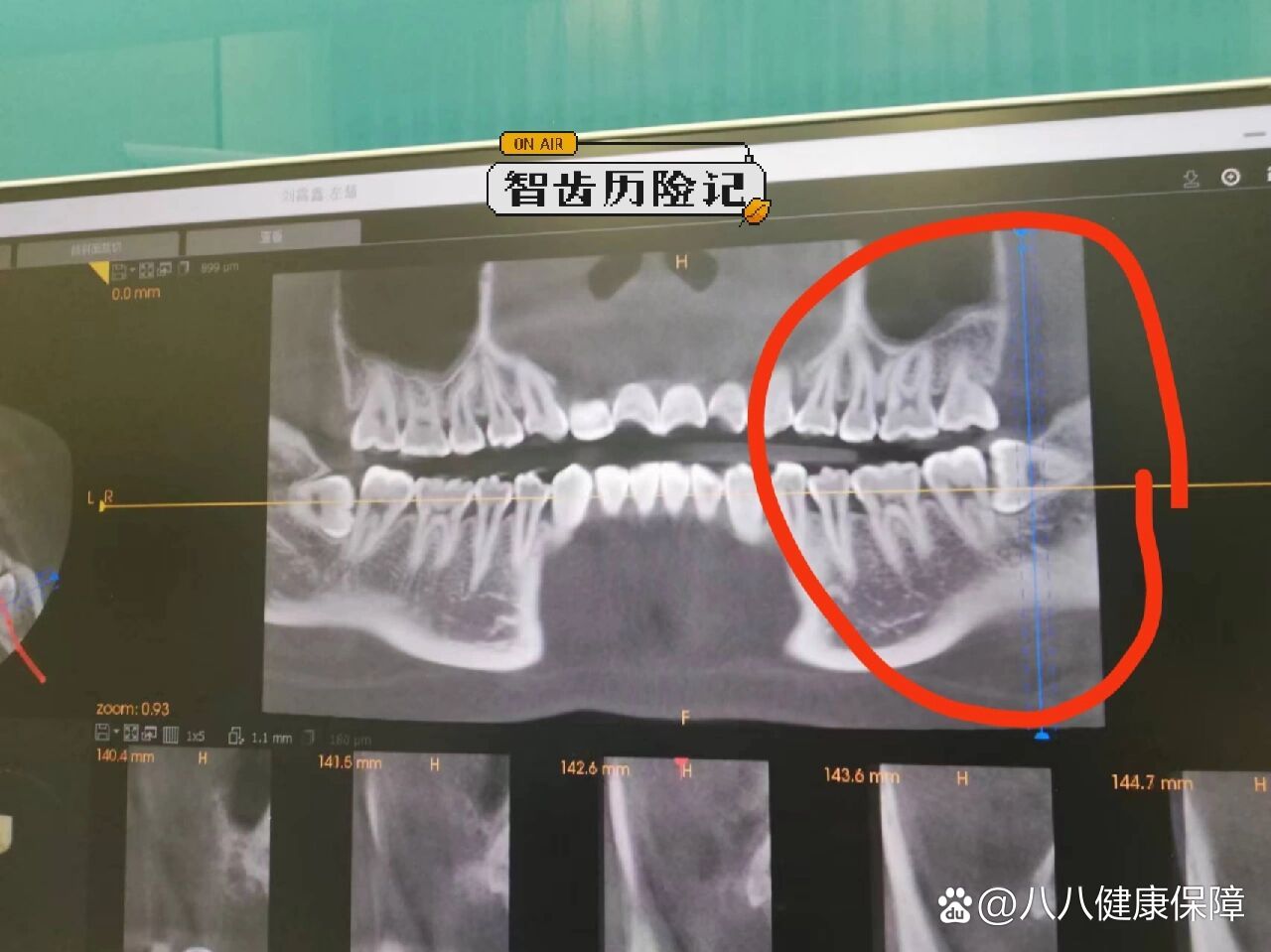 半埋伏智齿图片