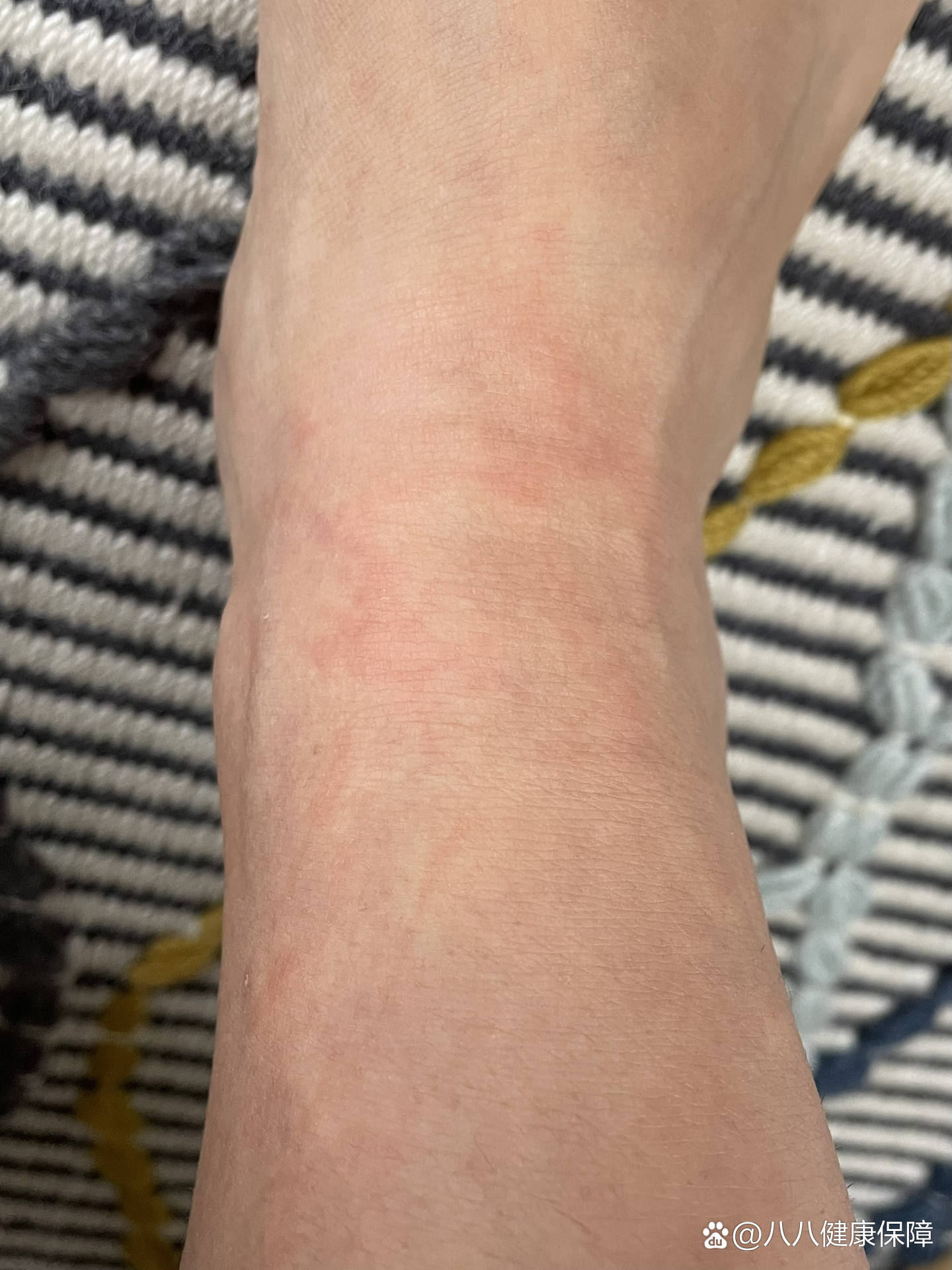 水母蛰伤一周后又痒了😭