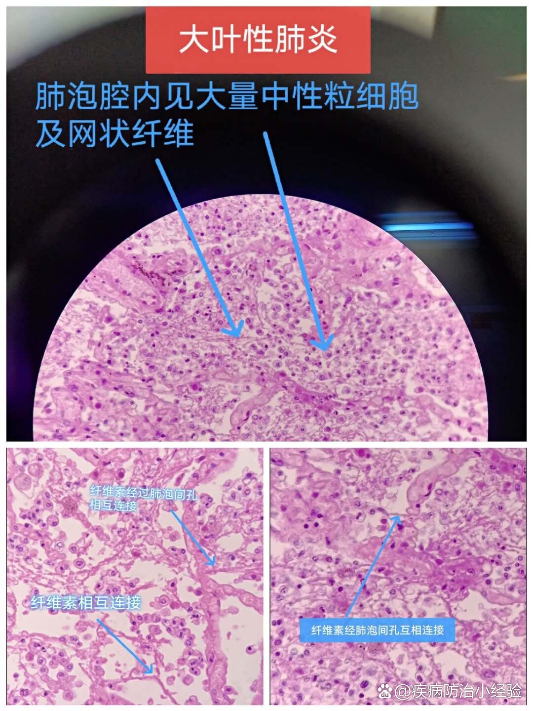 小叶性肺炎 br