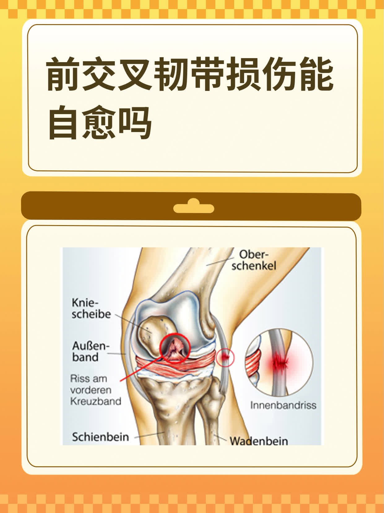 前交叉韧带损伤能自愈吗