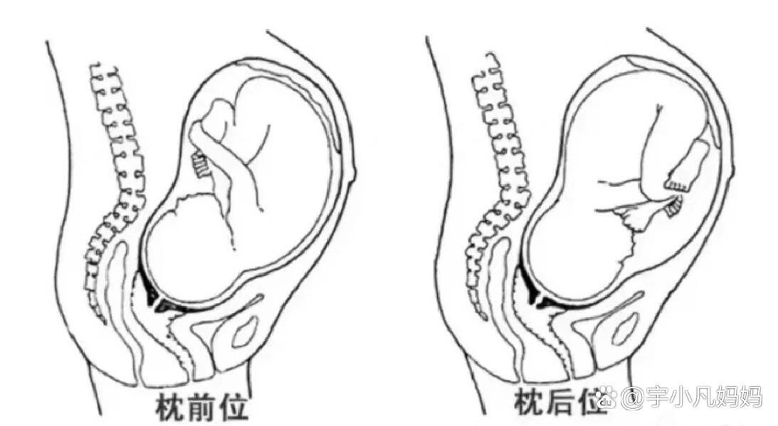 枕后位血泪教训