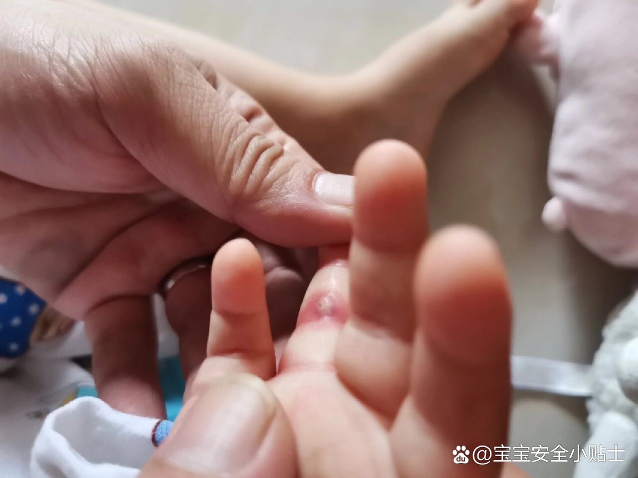 宝宝突然手指肿,有脓包!