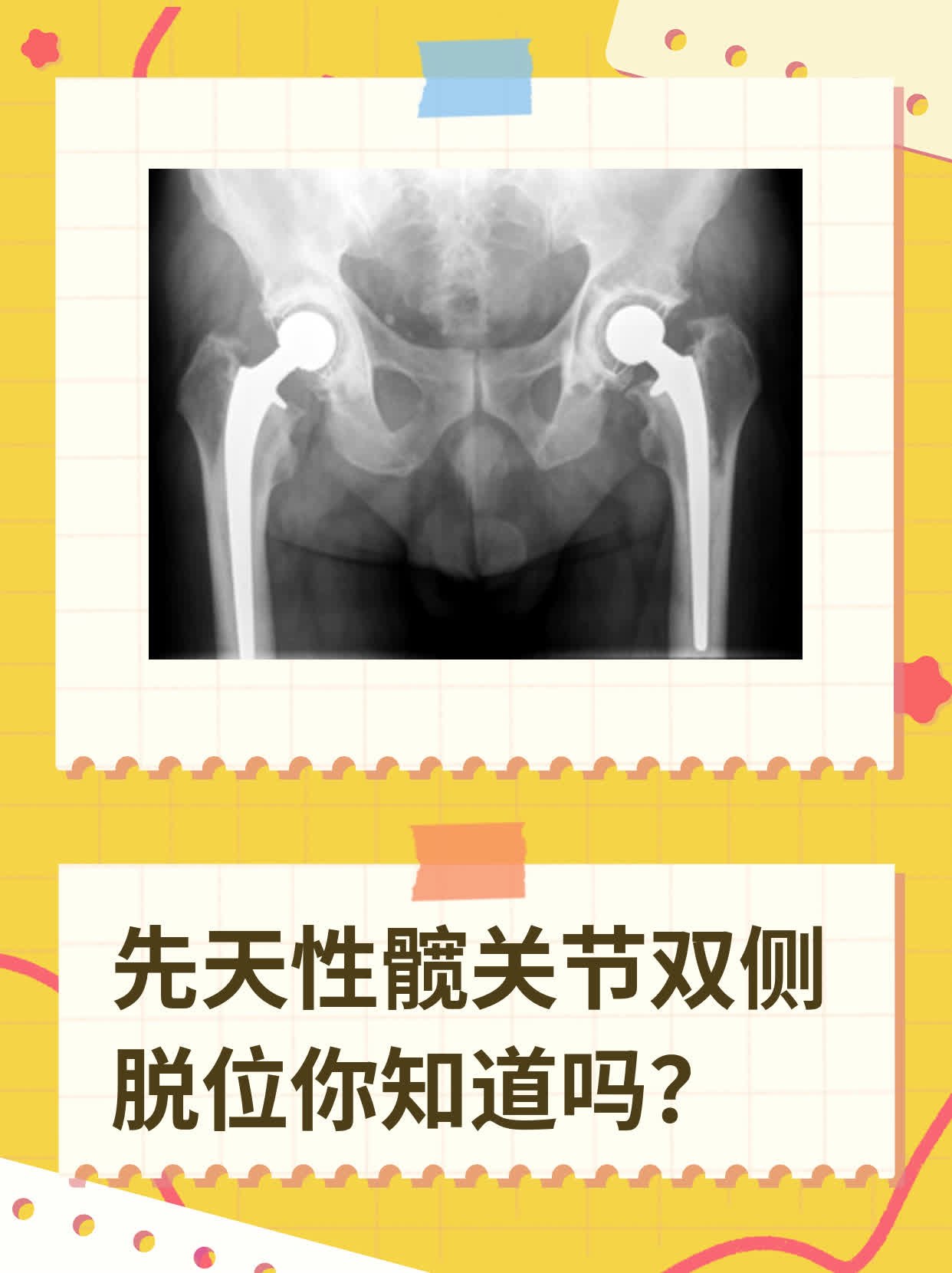 先天性髋关节双侧脱位你知道吗