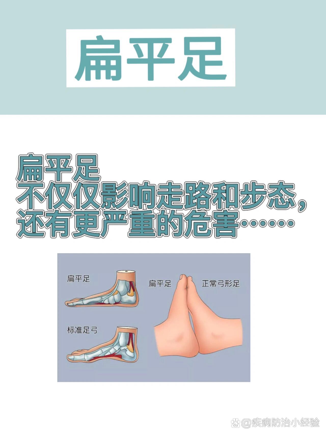 扁平足怎么办?
