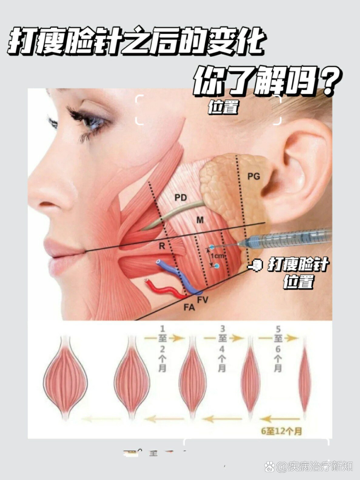 最近经常也有姐妹反馈乔乔说 04为什么我打完瘦脸针后脸颊部有凹陷