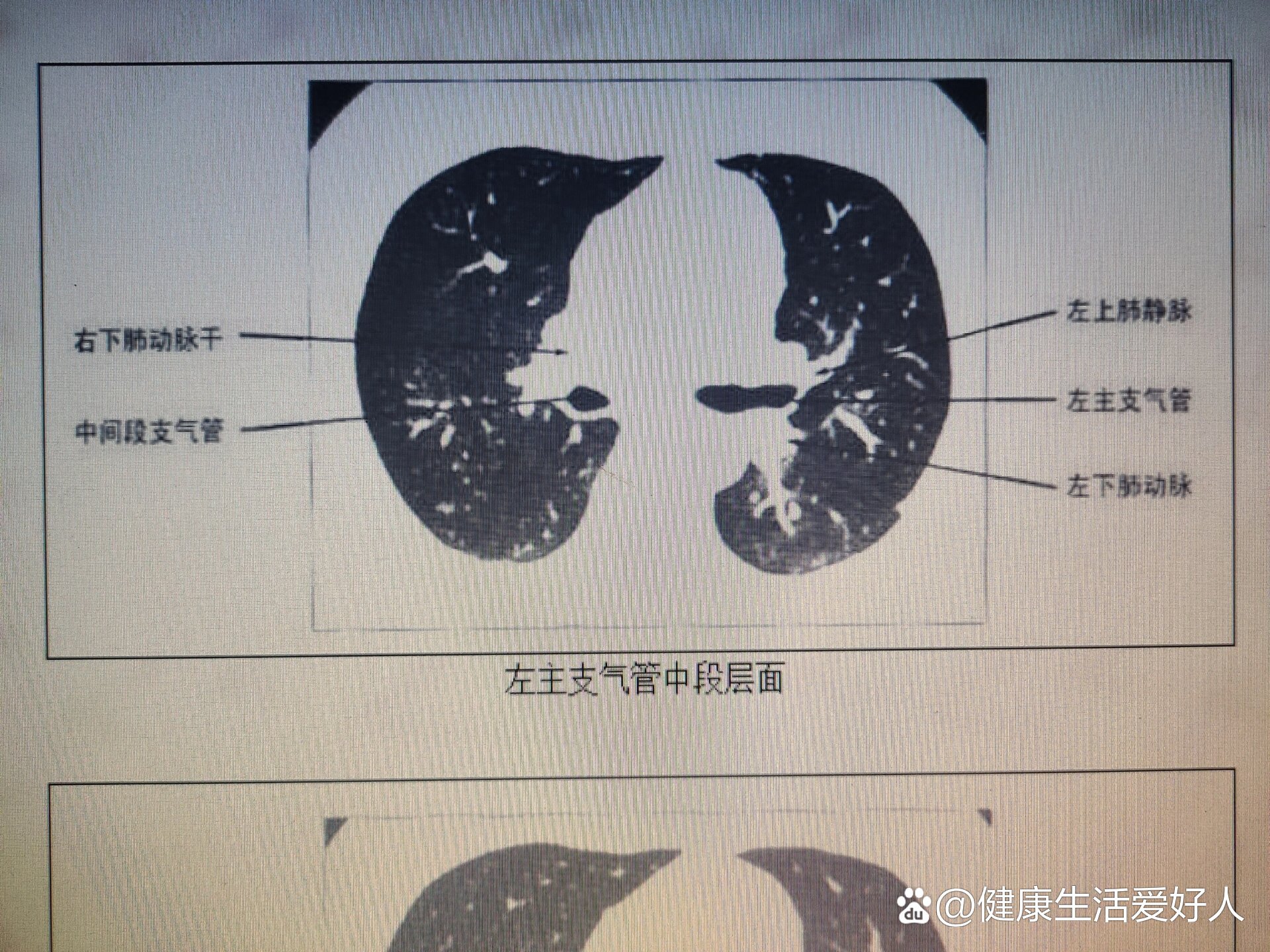 肺ct片子怎么看图片图片