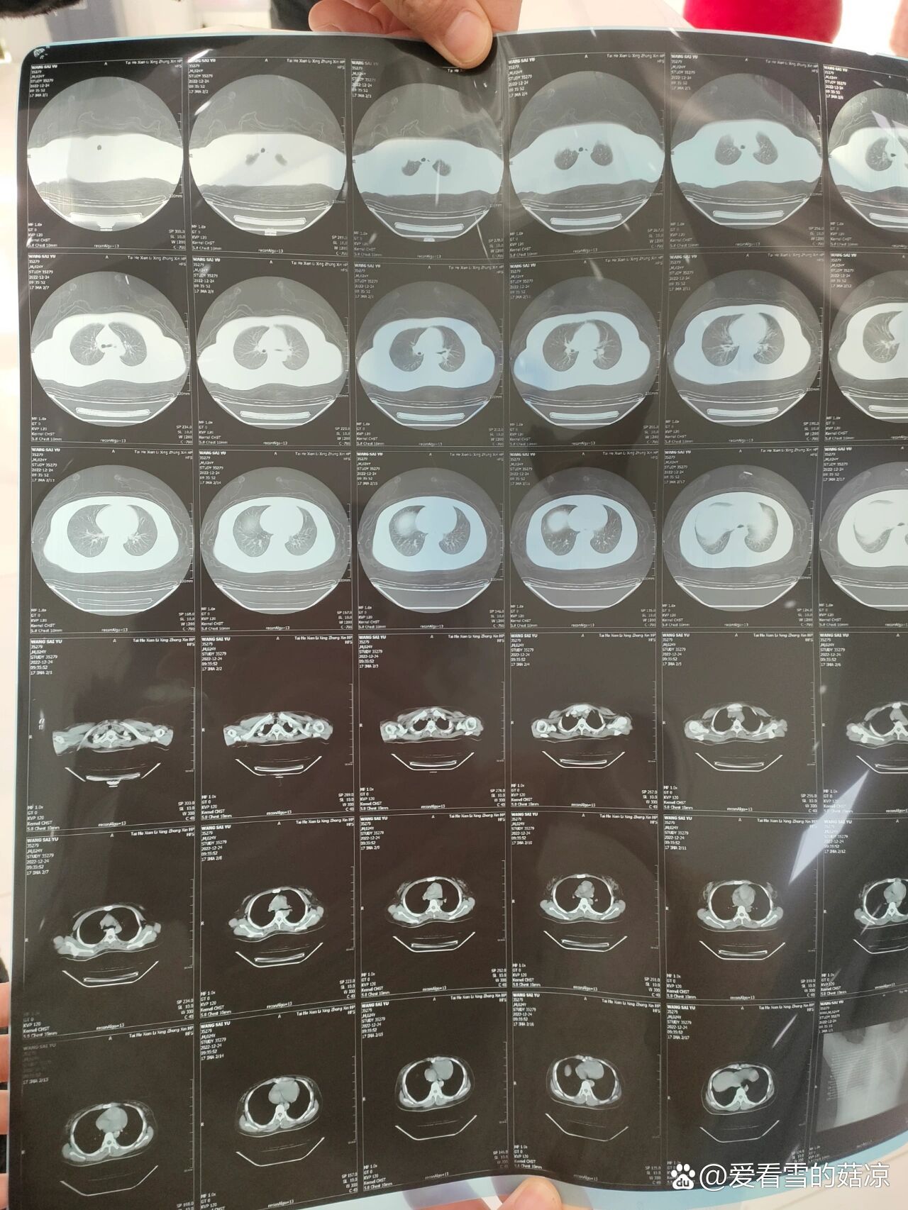 感染新冠双肺纹理增多