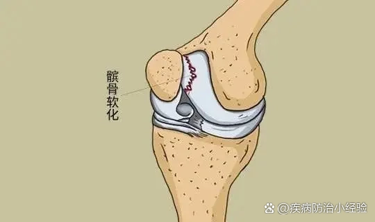 髌骨软化问题 br>髌骨软化并不是髌骨骨头变软了,而是髌下软骨的损伤